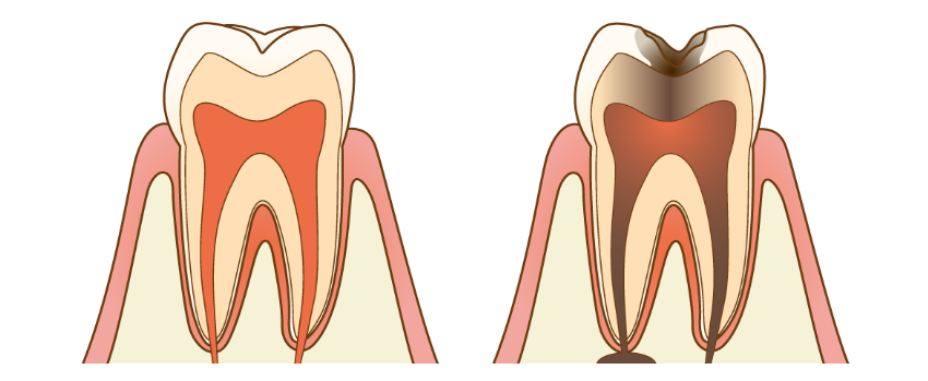左：健康な歯　/ 右：感染されている歯