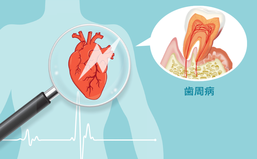 死因第2位の恐ろしい心臓発作は、歯周病が原因！？