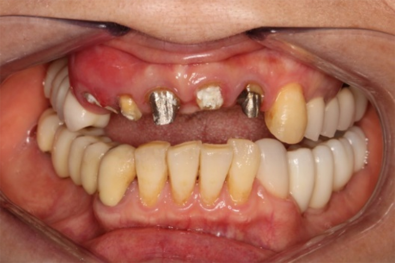 古い被せ物をした治療前の歯