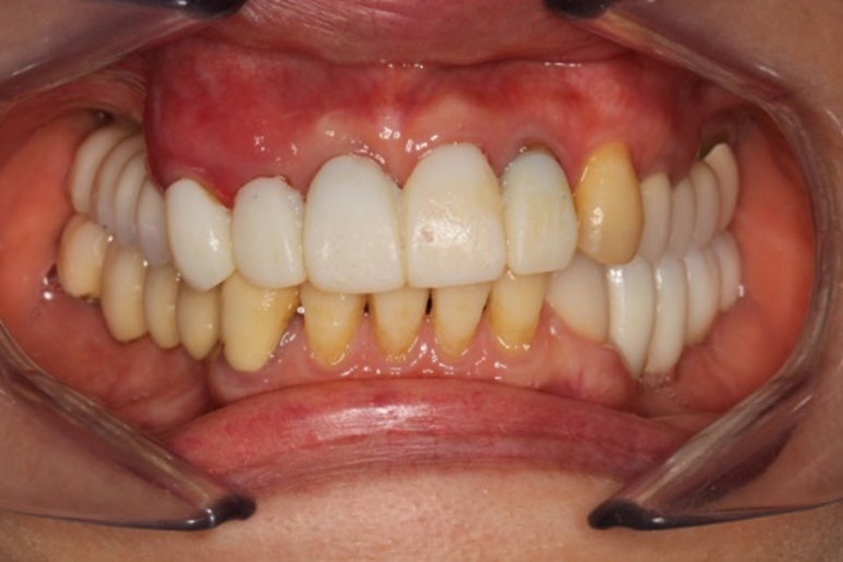 治療後の仮歯