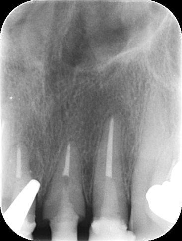 歯のレントゲン