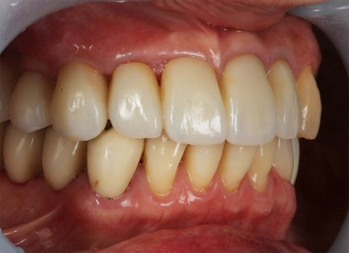 治療終了後の歯