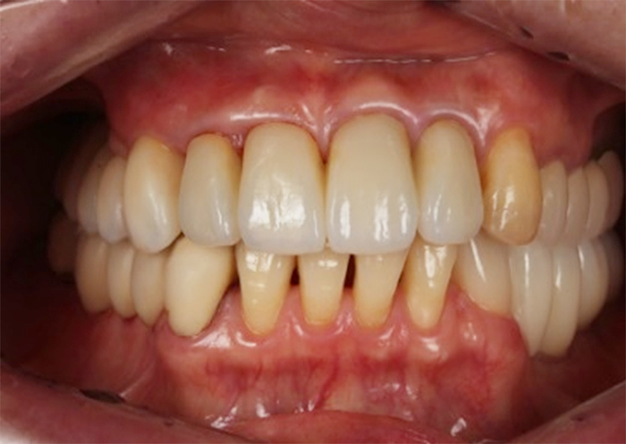 治療終了後の歯