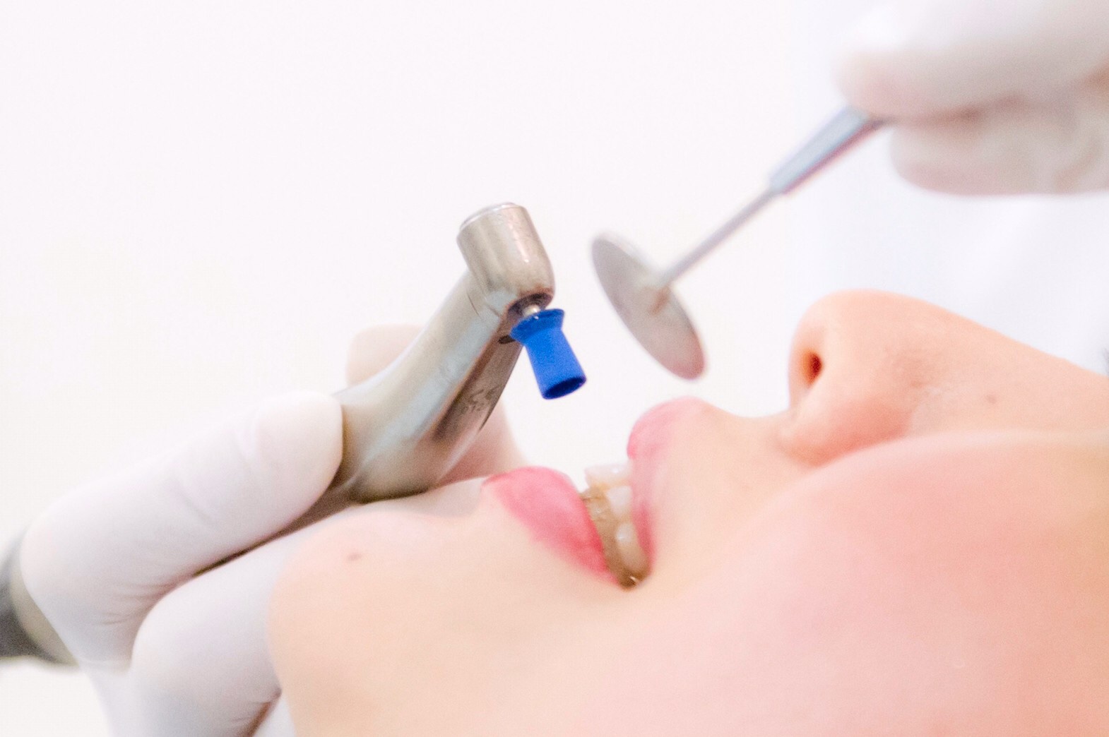 歯科（予防）メンテナンスで、治療後の正しいチェックアップを！